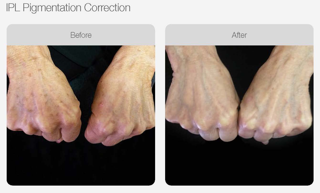 IPL Pigmentation Correction Before and After